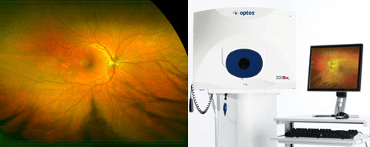 Optos Retinal Map